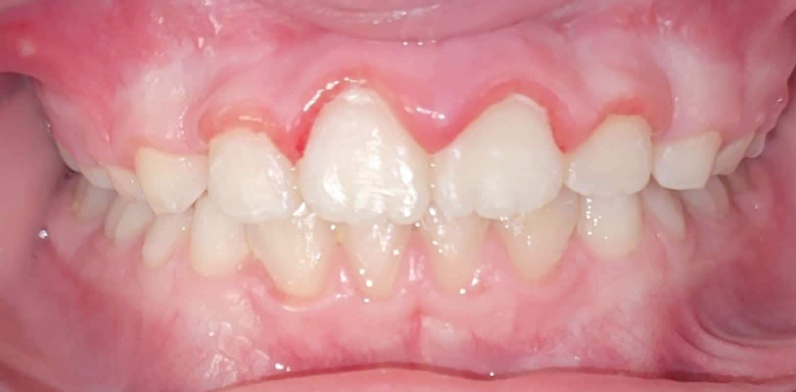 Orthodontics for all ages 12 After phase 1 orthodontic treatment showing improved alignment and spacing at hidden smiles orthodontics