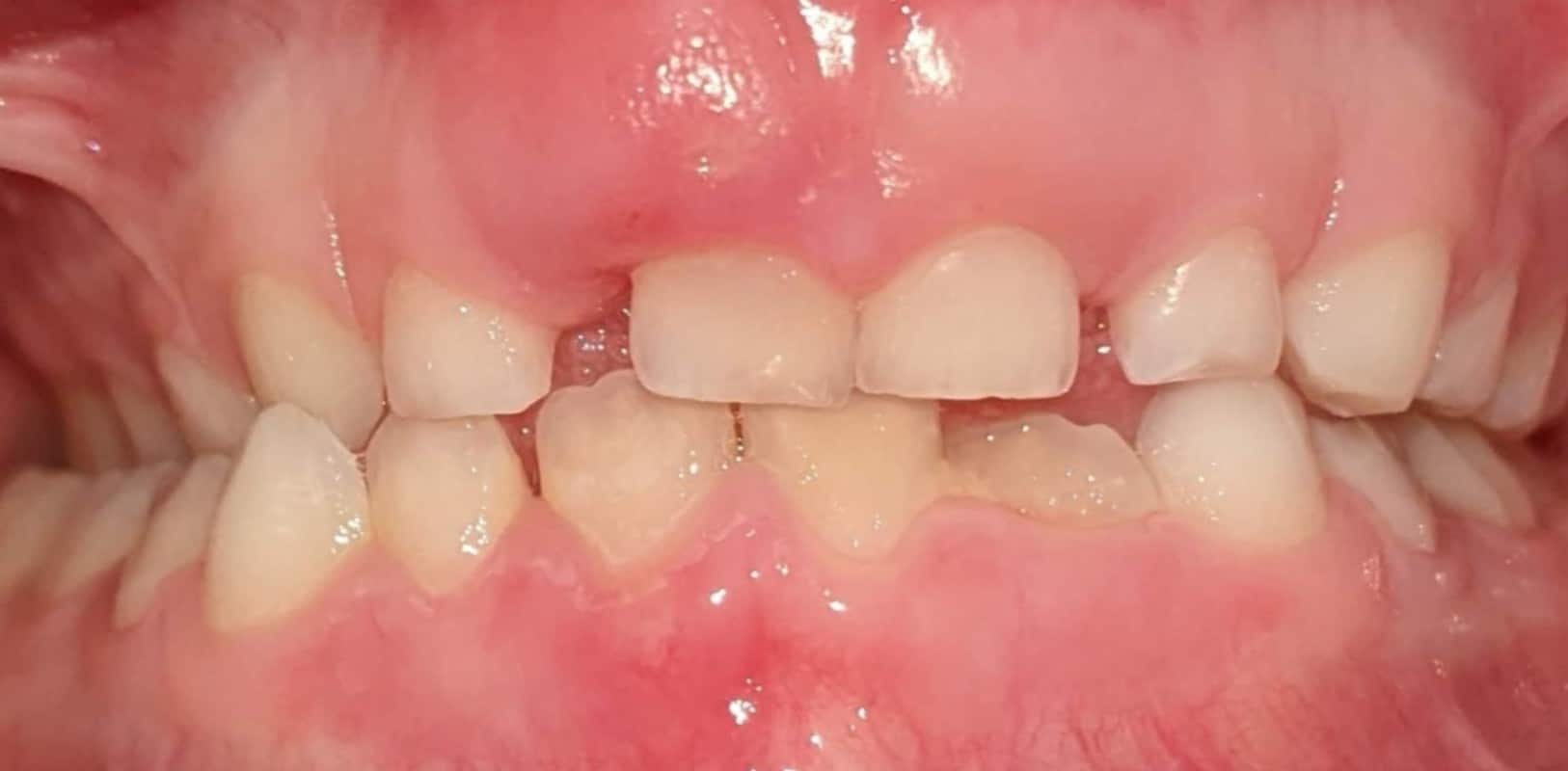 Orthodontics for all ages 11 Before phase 1 orthodontic care showing crowding and misalignment in a child’s smile at hidden smiles