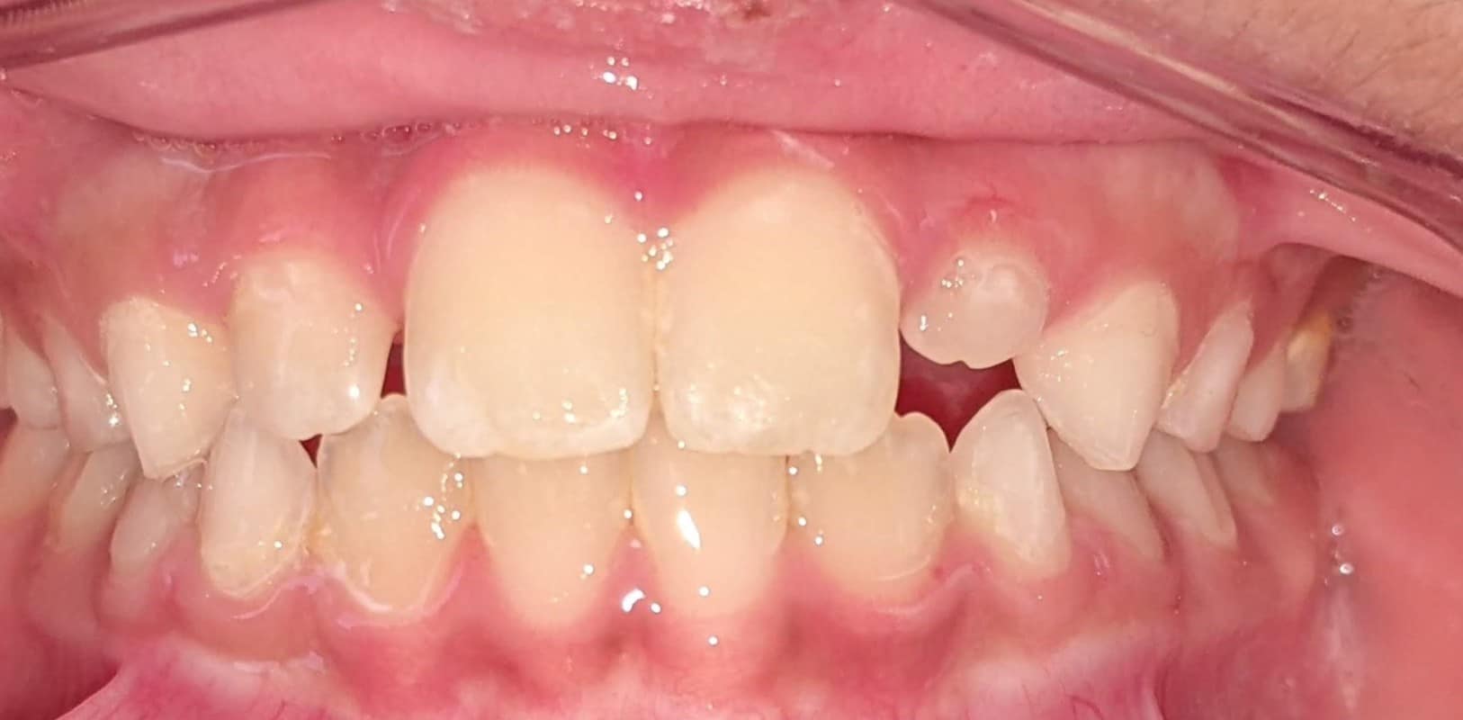 Invisalign® 12 Fully aligned smile after comprehensive orthodontic treatment in melville ny