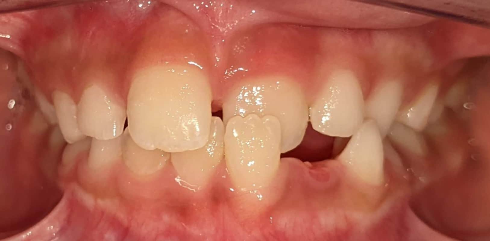 Invisalign® 11 Severe crowding and spacing issues before orthodontic treatment in melville ny