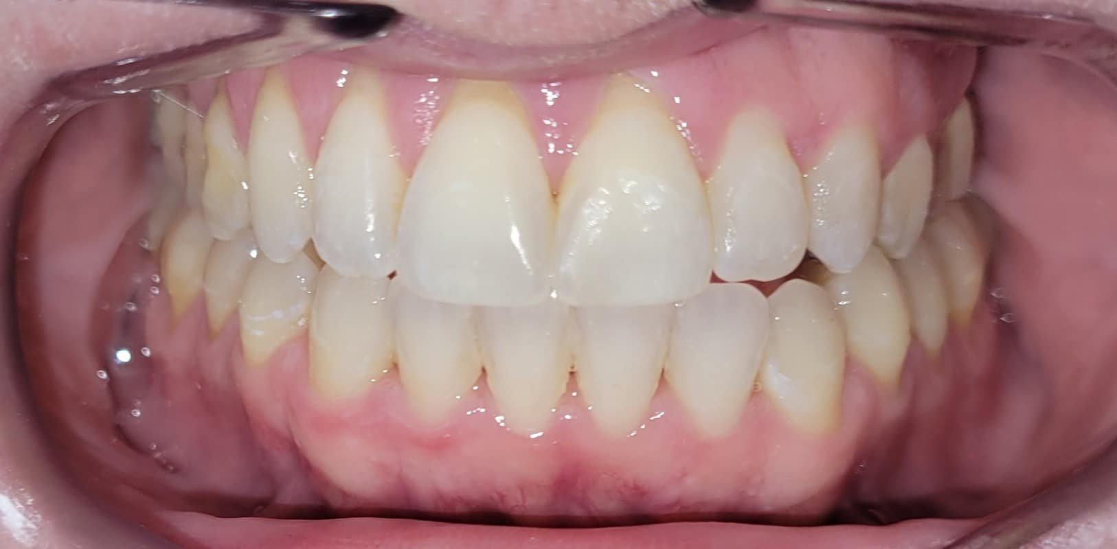 Invisalign® 10 Straight, healthy smile after orthodontic care in melville ny