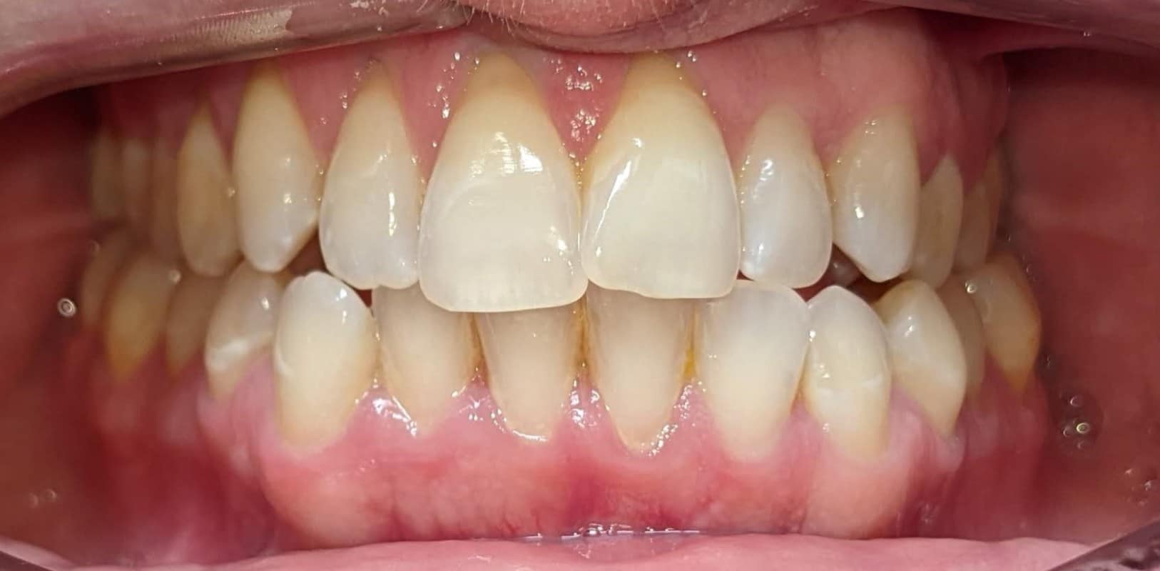 Invisalign® 9 Uneven teeth and spacing before orthodontic treatment in melville ny