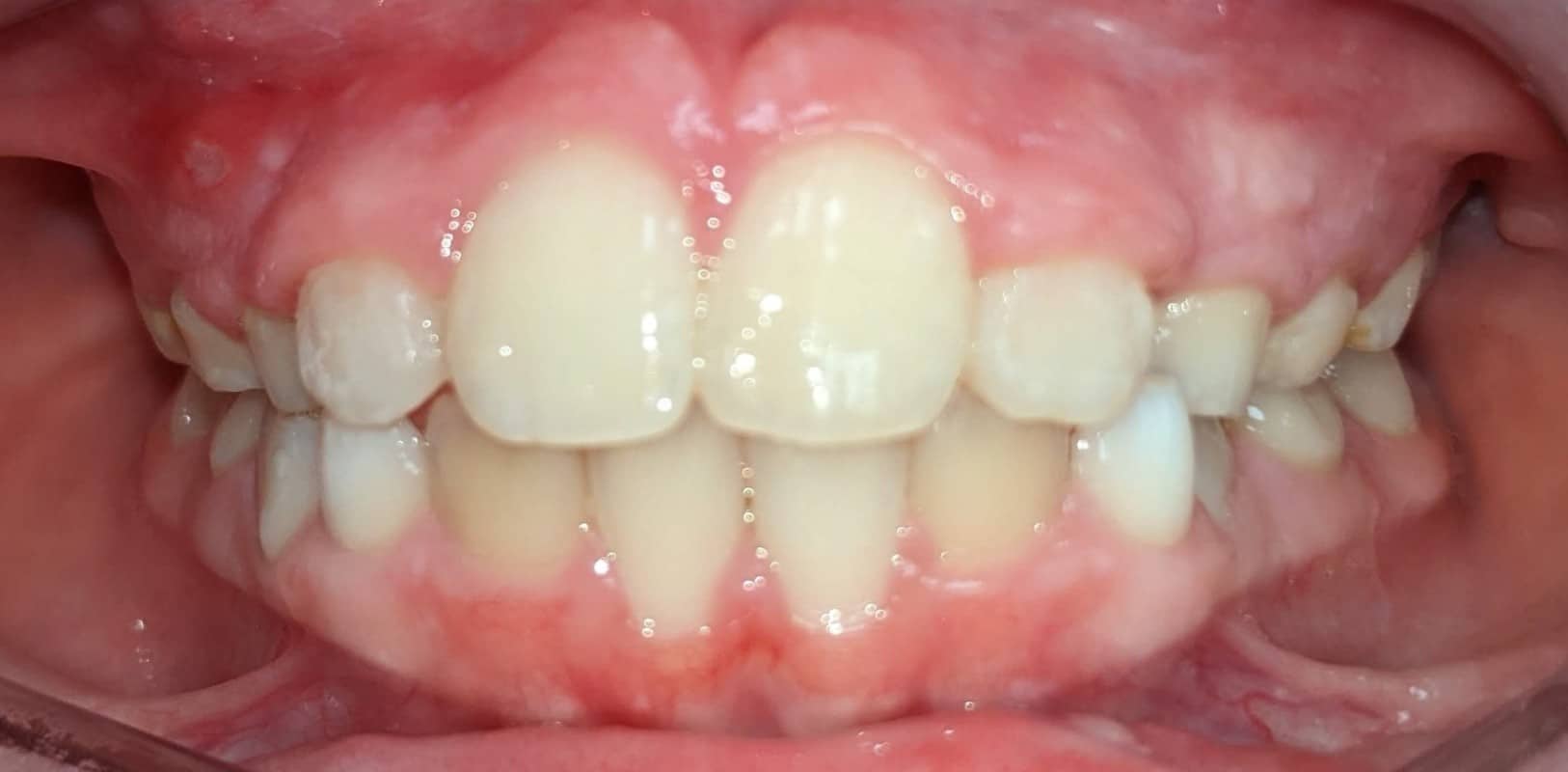 Orthodontics for all ages 4 Phase 1 orthodontic results improving alignment and spacing in a developing smile at hidden smiles orthodontics