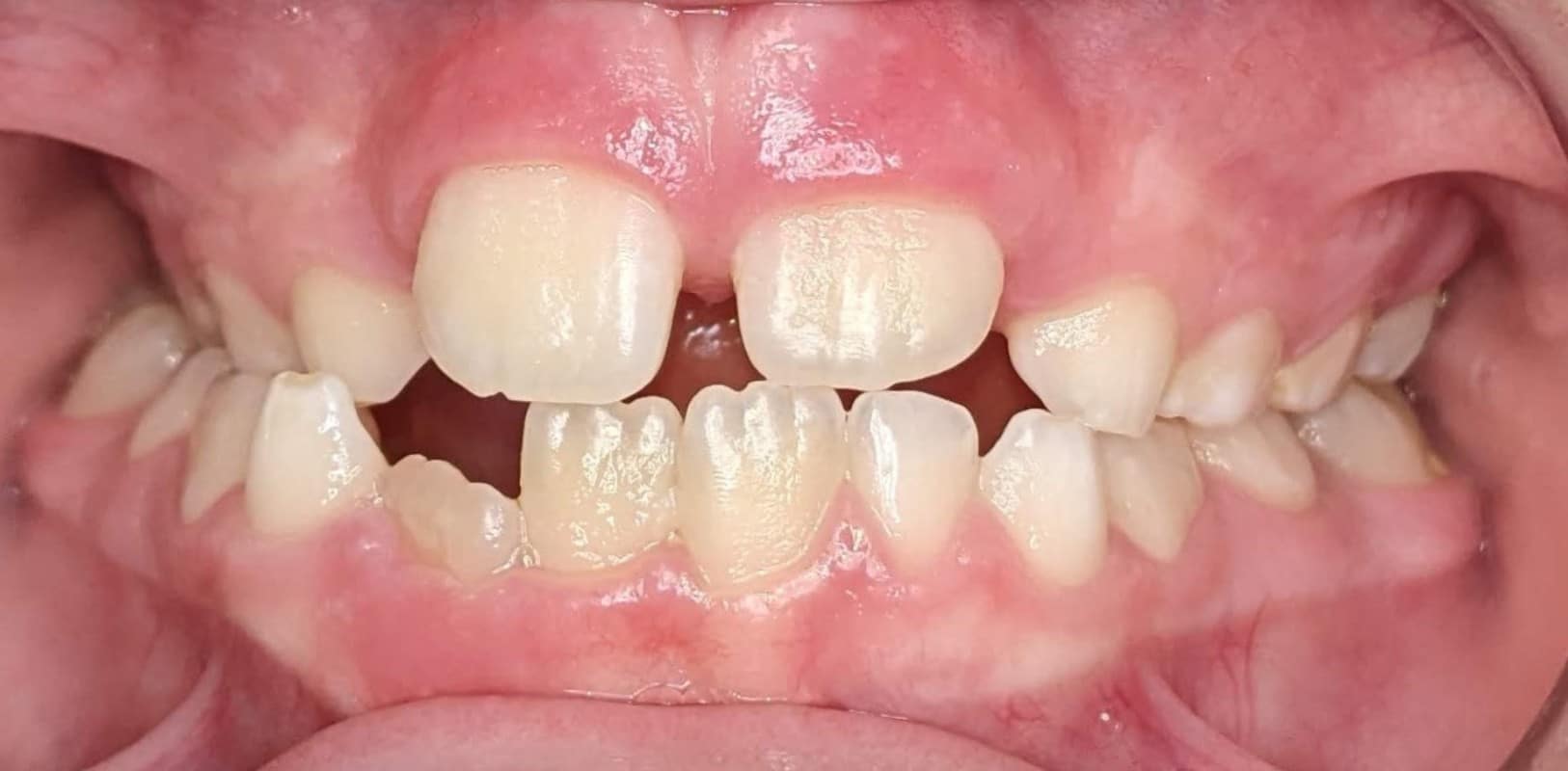 Orthodontics for all ages 3 Early orthodontic treatment before phase 1 showing crowding and spacing issues in developing smile at hidden smiles orthodontics