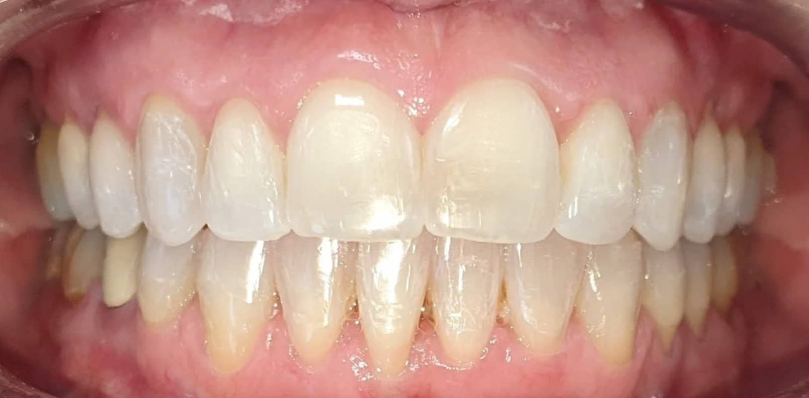 Invisalign® 8 Straight teeth and improved bite after invisalign in melville ny