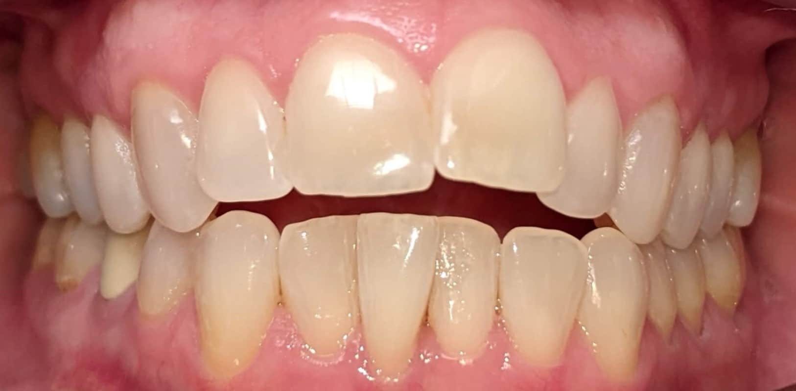 Invisalign® 7 Misaligned teeth and bite issues before invisalign treatment in melville ny