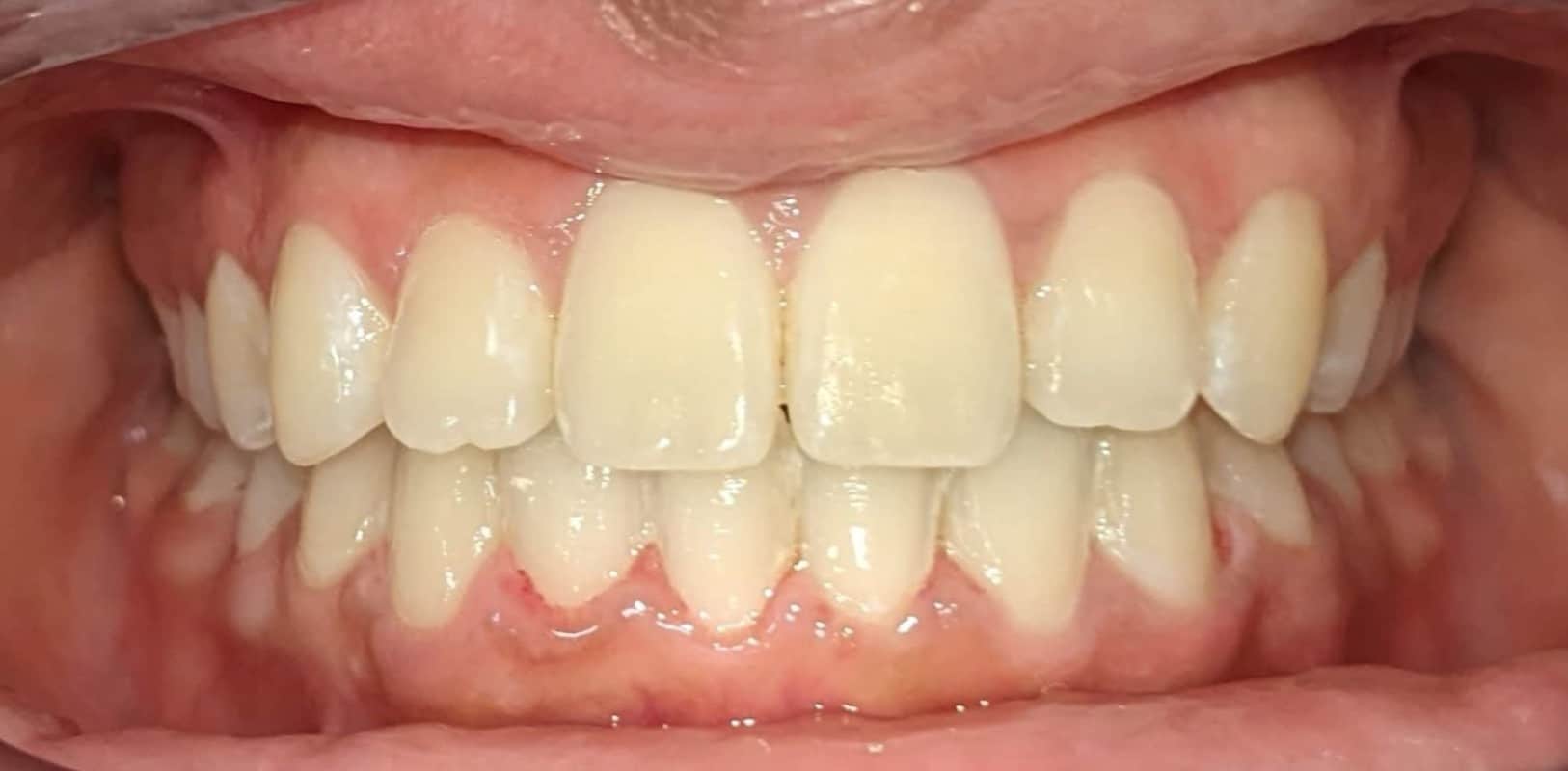 Lightforce clear braces 4 After ceramic braces treatment showing improved spacing and a balanced smile in new york