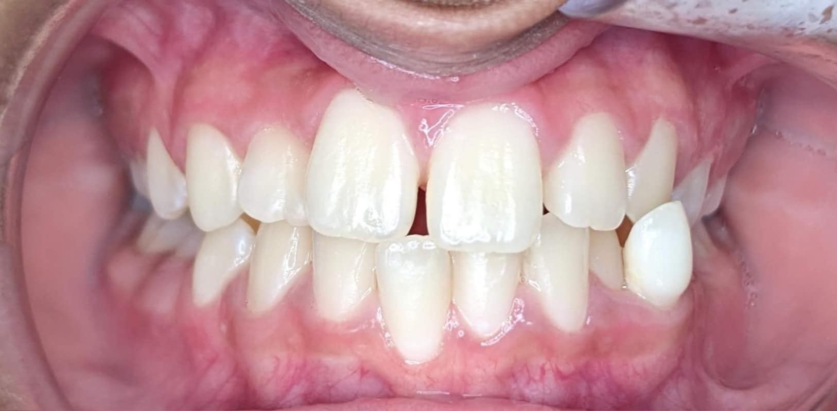 Lightforce clear braces 3 Before orthodontic treatment showing spacing and alignment concerns in new york at hidden smiles orthodontics