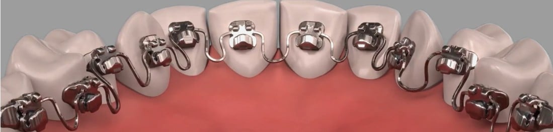 Hidden-smiles-inbrace-hidden-braces Inbrace hidden braces placed behind teeth for discreet orthodontic treatment at hidden smiles orthodontics in new york