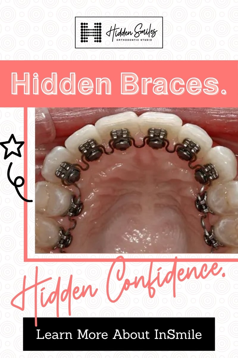 Hidden braces placed behind the teeth for discreet orthodontic treatment at Hidden Smiles Orthodontic Studio
