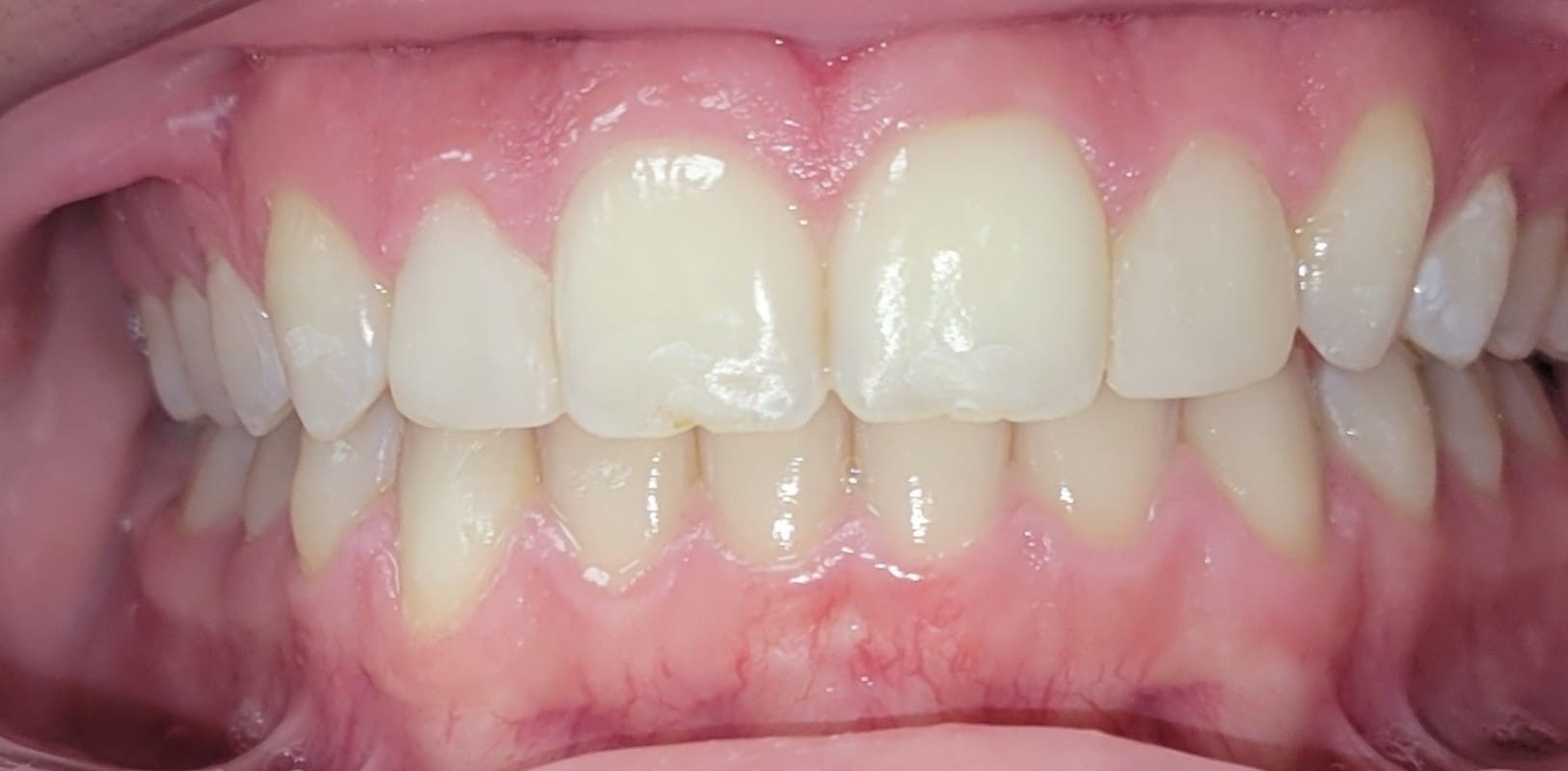 Invisalign® 14 Straight, healthy smile after orthodontic care in melville ny