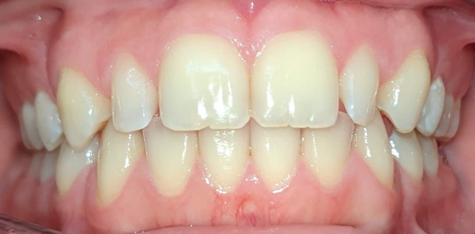Invisalign® 13 Misaligned bite and crowded teeth before treatment in melville ny