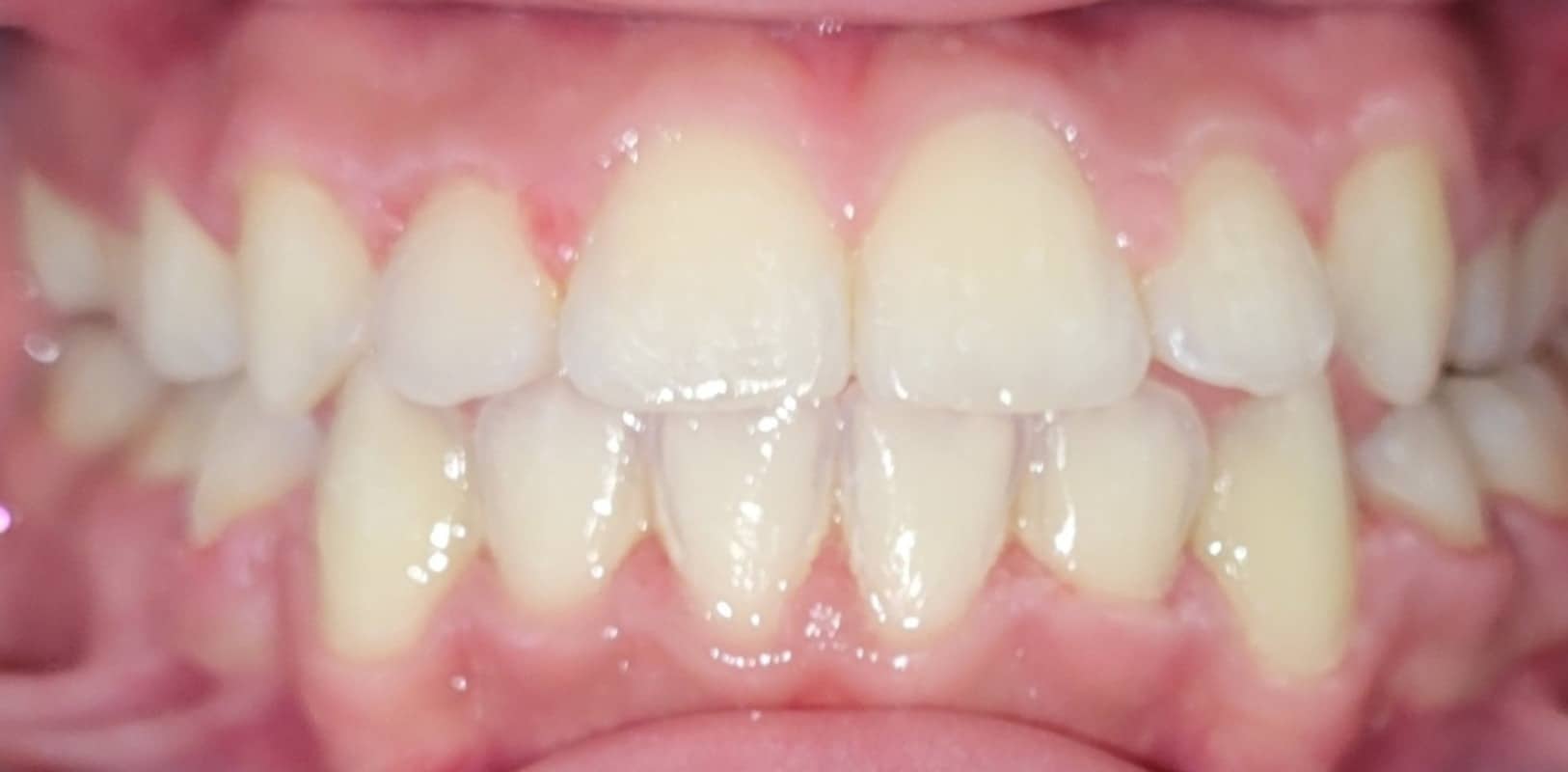 Metal braces 12 After braces treatment correcting spacing and alignment for a balanced smile in new york