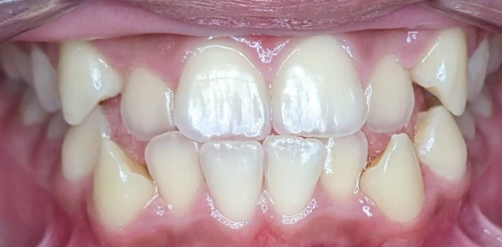 Metal braces 11 Before orthodontic treatment showing spacing and alignment issues in a young patient in new york