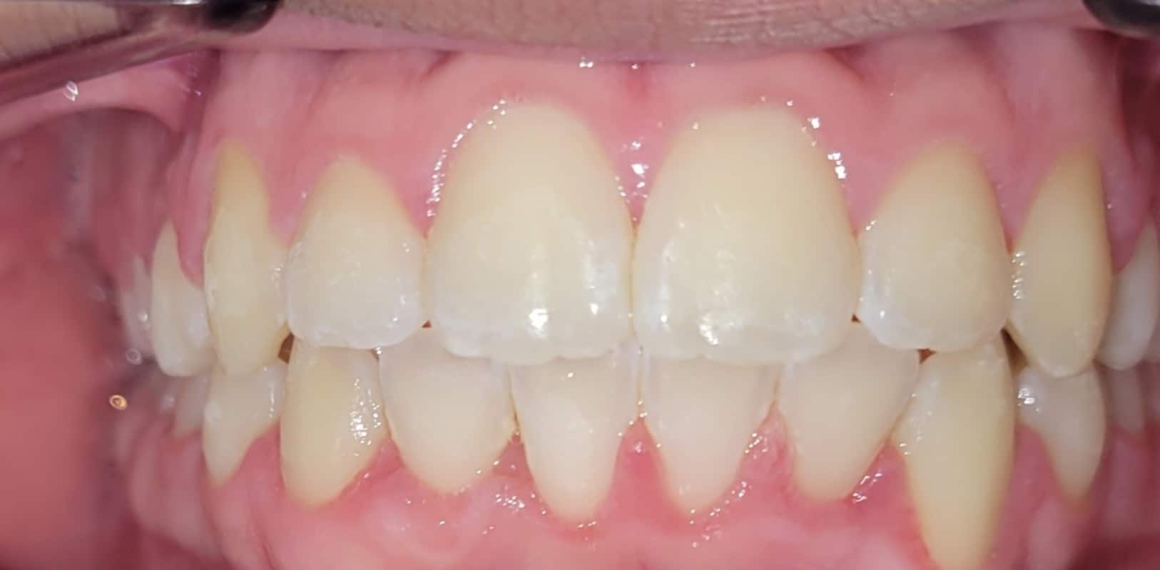 Metal braces 10 After braces treatment showing straightened teeth and improved smile alignment at hidden smiles orthodontics new york