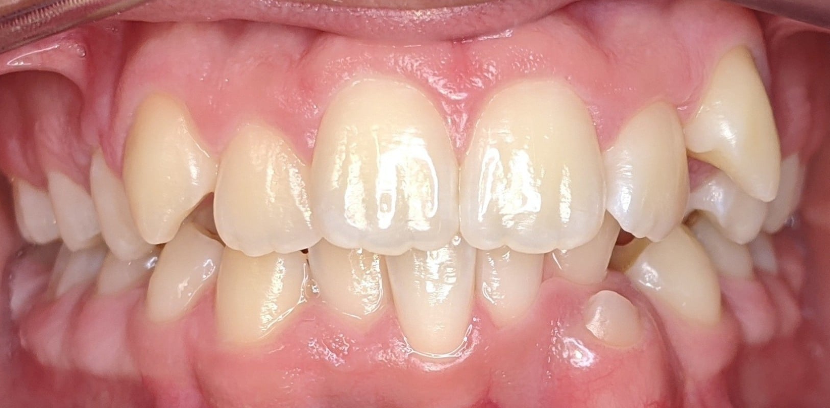Metal braces 9 Before braces showing crowded and misaligned teeth in a teen patient at hidden smiles orthodontics in new york