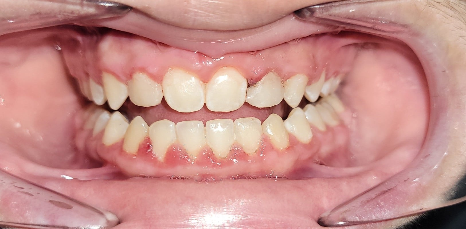 Metal braces 4 After braces treatment showing improved alignment and confident smile in new york