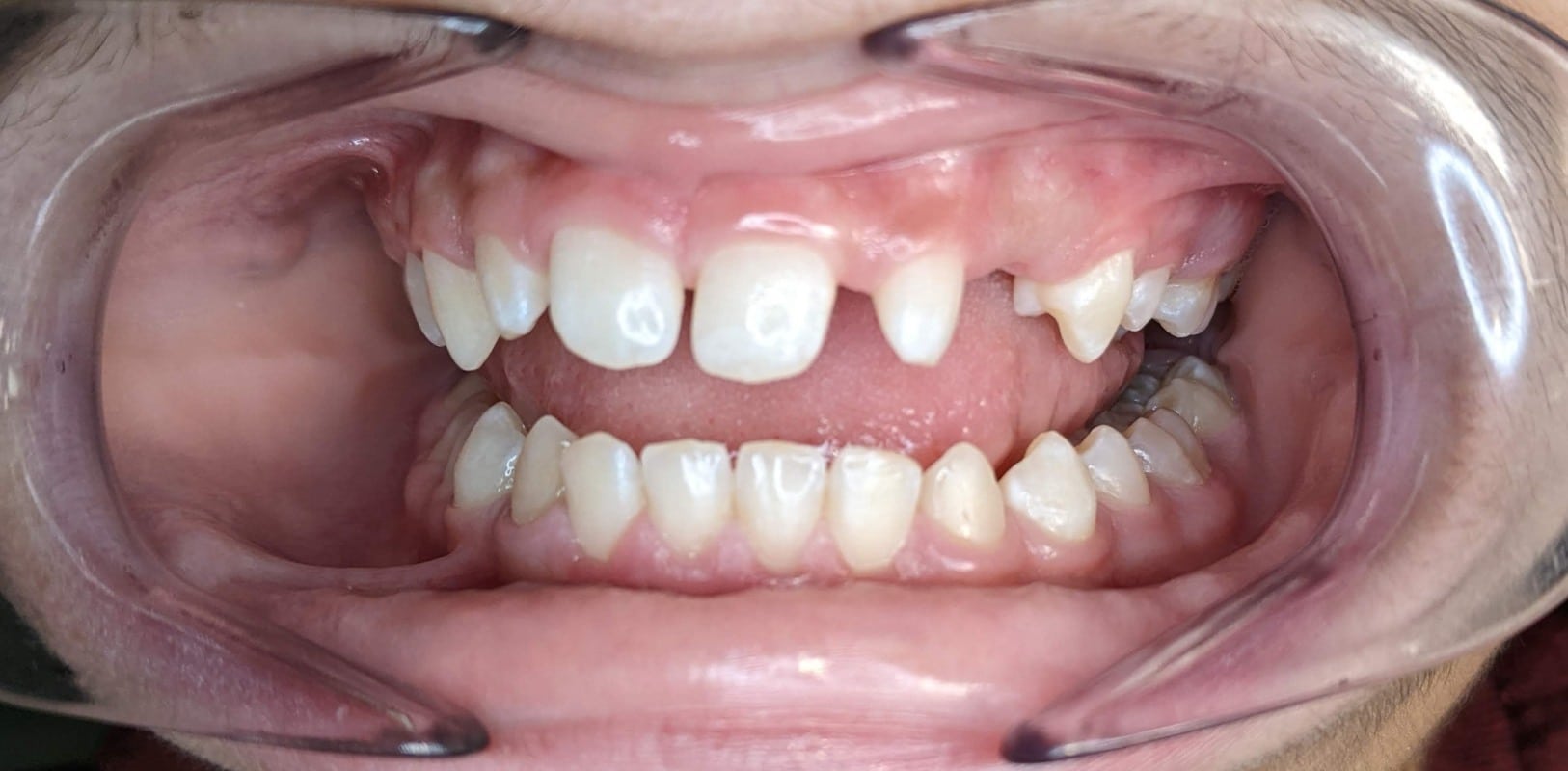 Metal braces 3 Before braces showing misaligned teeth and spacing issues in new york orthodontic patient