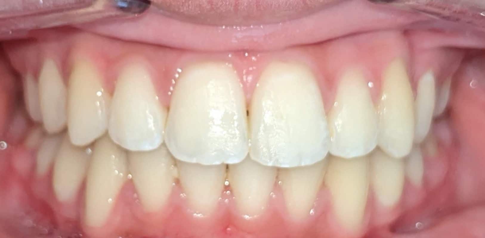 Metal braces 14 After orthodontic treatment showing straight teeth and improved bite alignment in new york