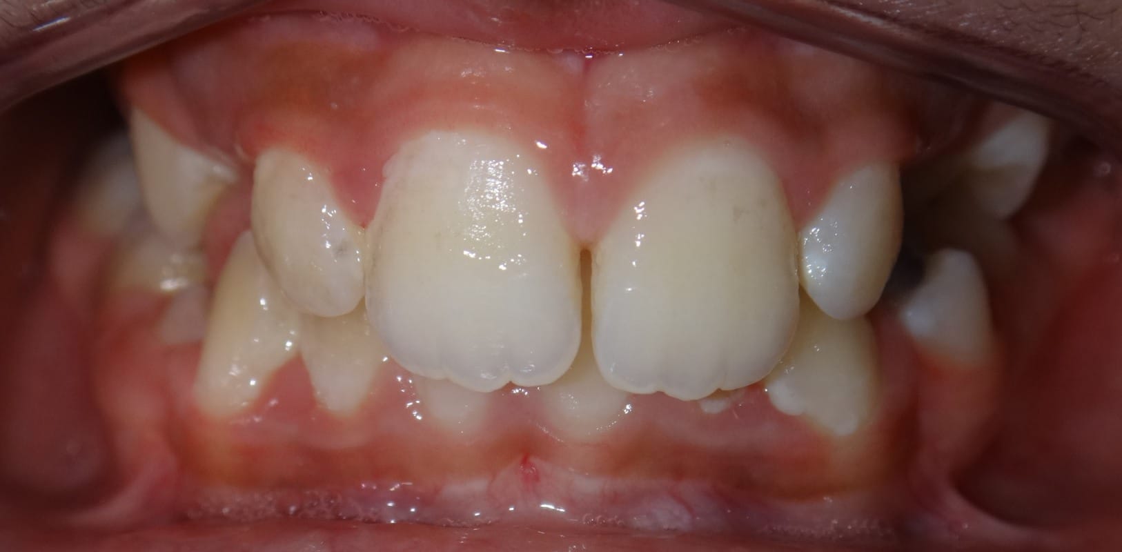 Metal braces 13 Before braces showing crowding and uneven teeth alignment at hidden smiles orthodontics new york
