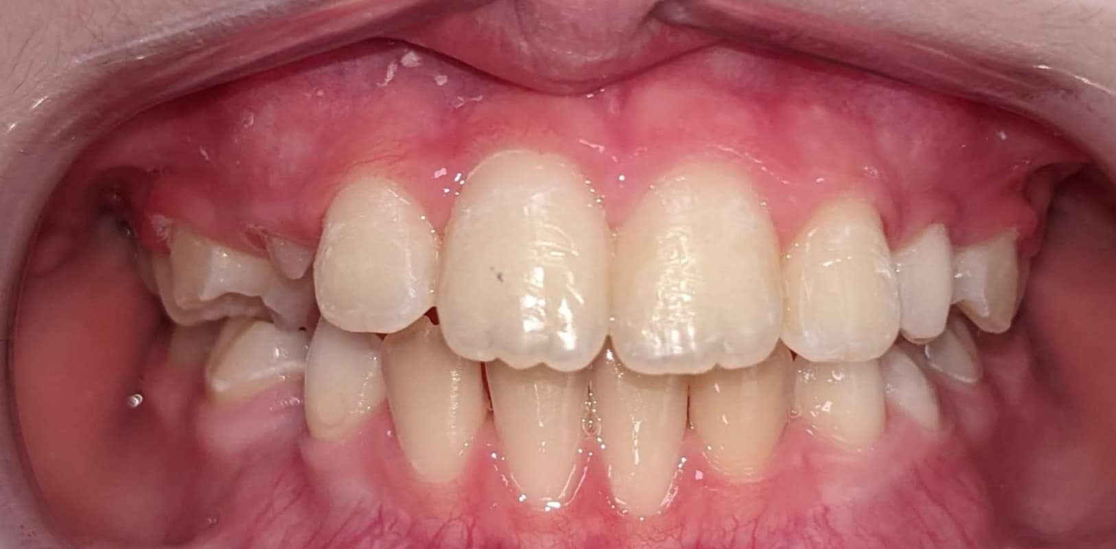 Orthodontics for all ages 10 After phase 1 orthodontics with improved spacing and bite alignment at hidden smiles orthodontics