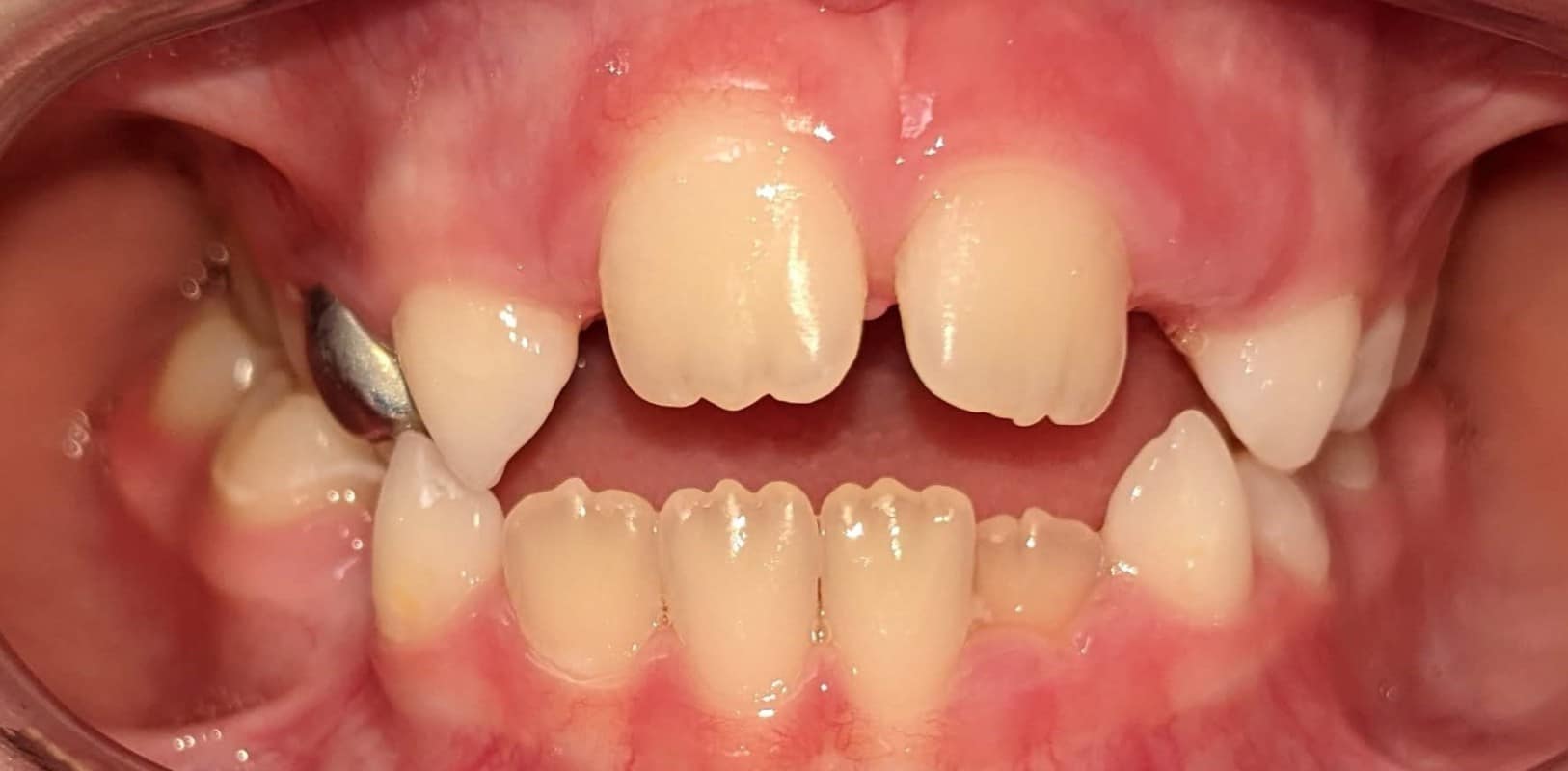 Orthodontics for all ages 9 Before phase 1 orthodontic treatment showing spacing and bite concerns in a developing smile at hidden smiles