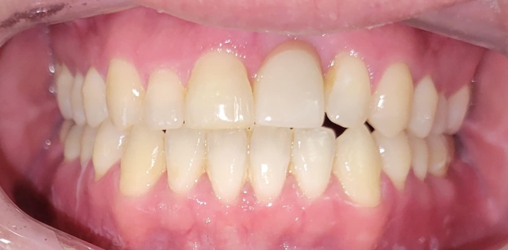 Invisalign® 6 Even, straight smile after orthodontic treatment in melville ny