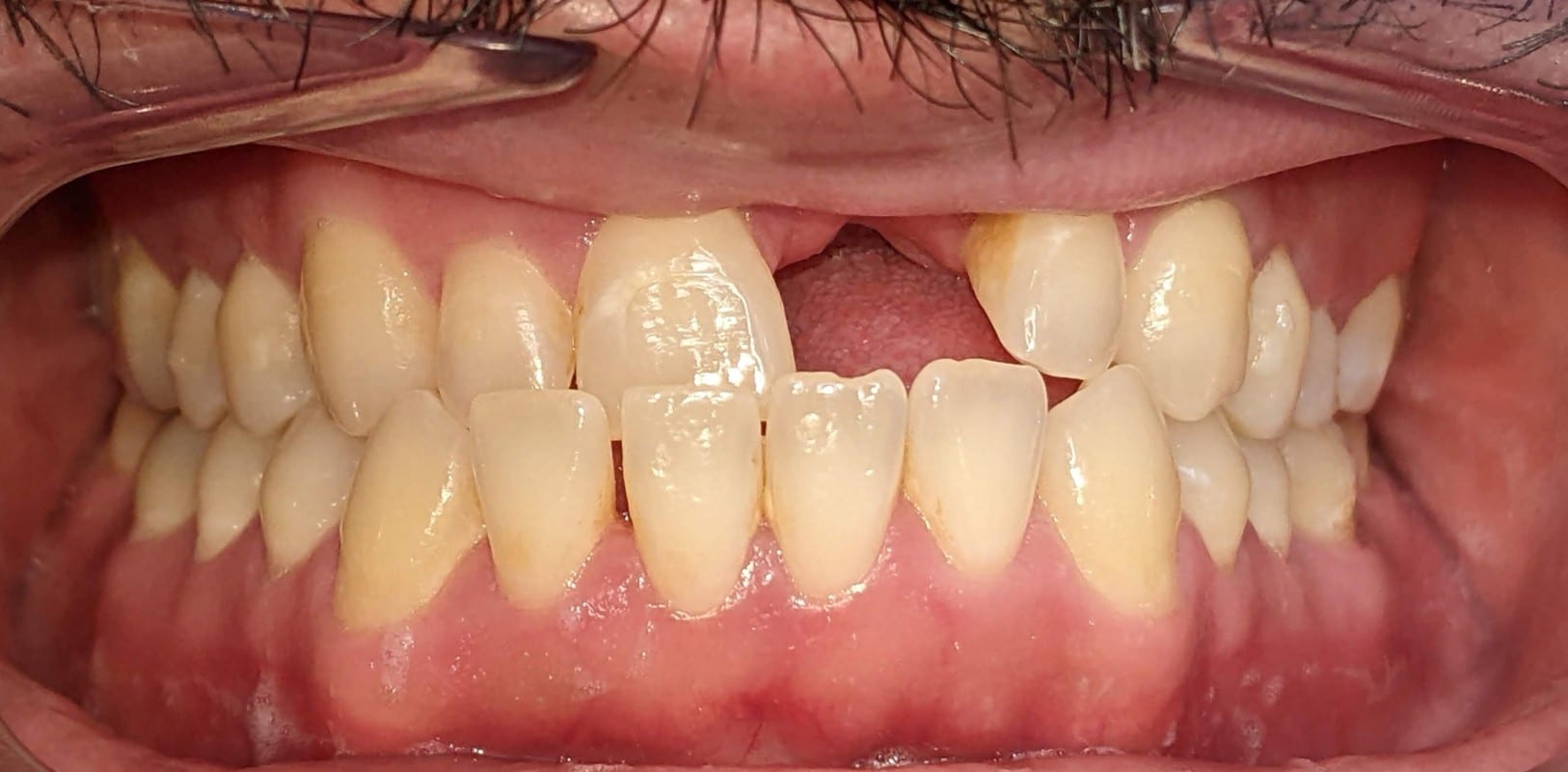 Invisalign® 5 Gaps and uneven teeth before orthodontic treatment in melville ny