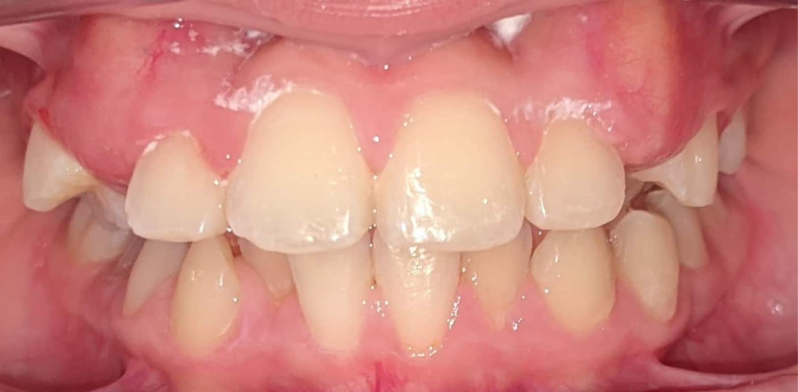 Orthodontics for all ages 8 After phase 1 orthodontic treatment improving tooth alignment and spacing in a developing smile at hidden smiles