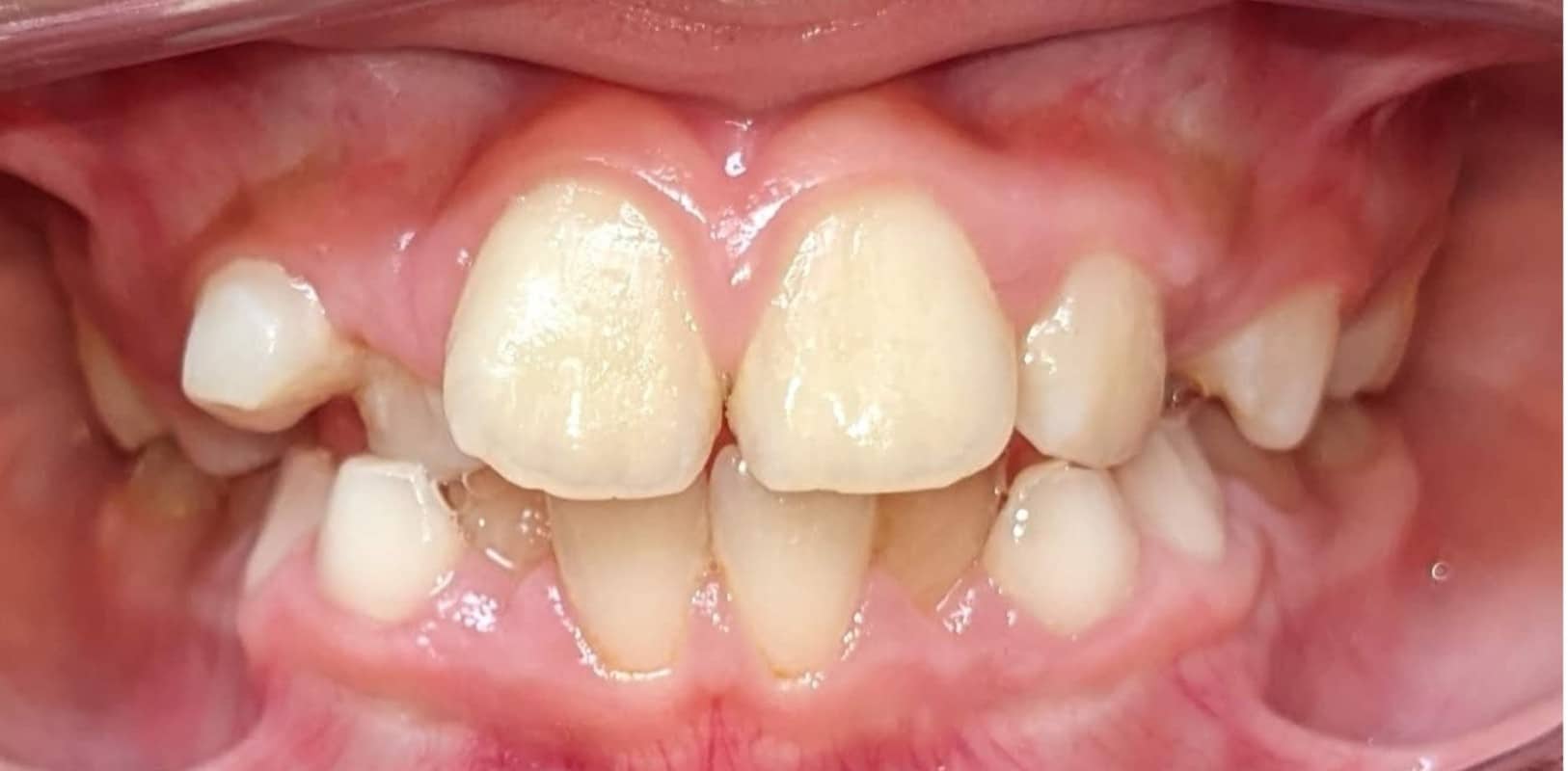 Orthodontics for all ages 7 Before phase 1 orthodontics showing significant crowding and misalignment in a child’s teeth at hidden smiles