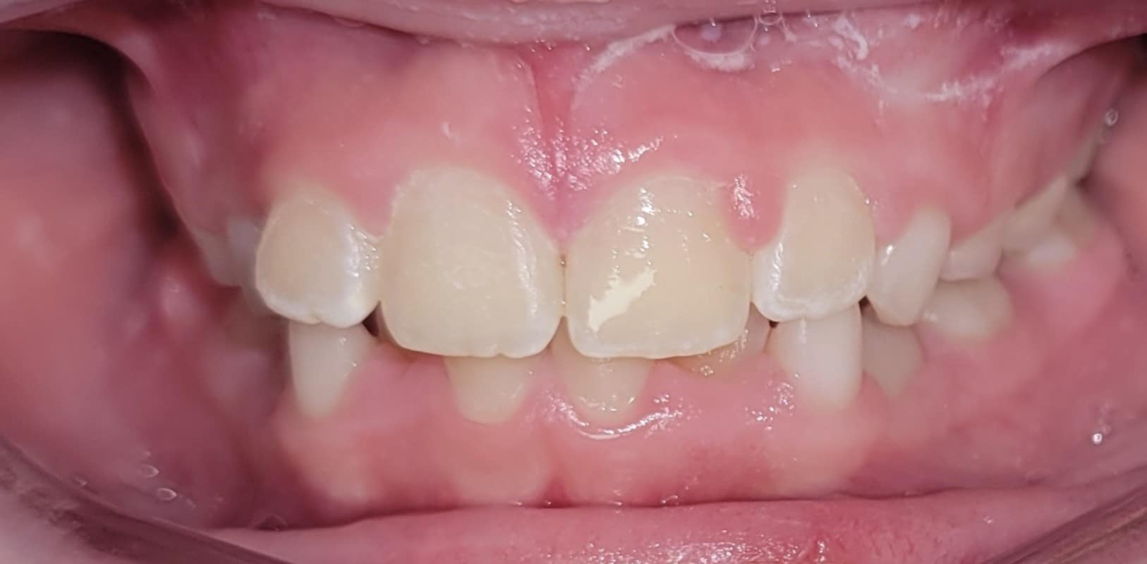 Orthodontics for all ages 14 Phase 1 orthodontic results improving alignment and spacing in a developing smile at hidden smiles orthodontics