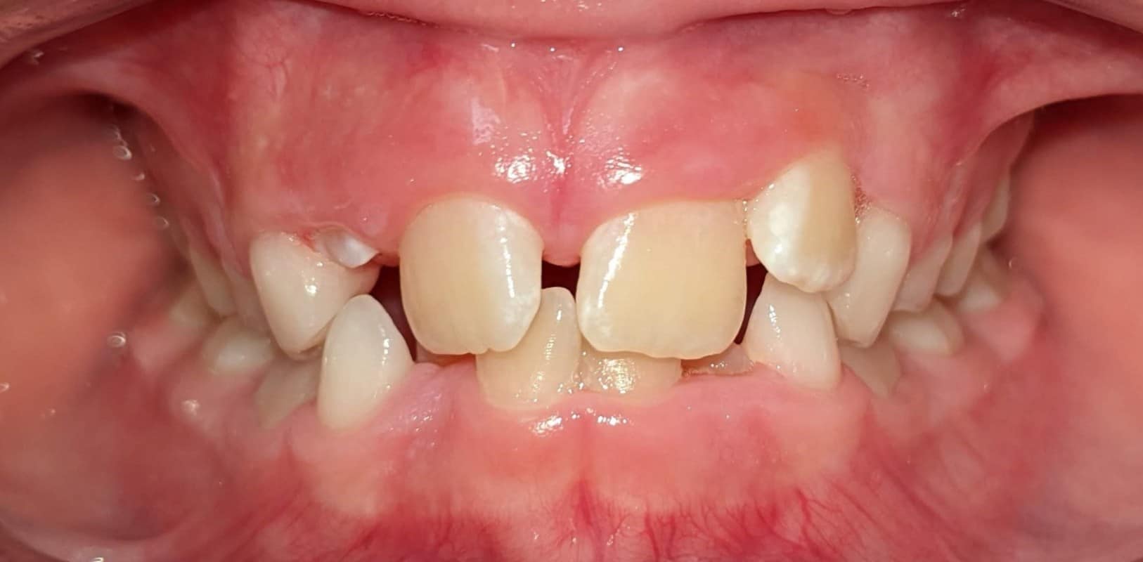 Orthodontics for all ages 13 Early orthodontic treatment before phase 1 showing crowding and spacing issues in developing smile at hidden smiles orthodontics