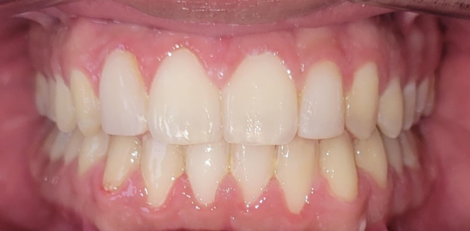 Lightforce clear braces 6 After ceramic braces treatment showing straight teeth and improved alignment in new york orthodontic patient