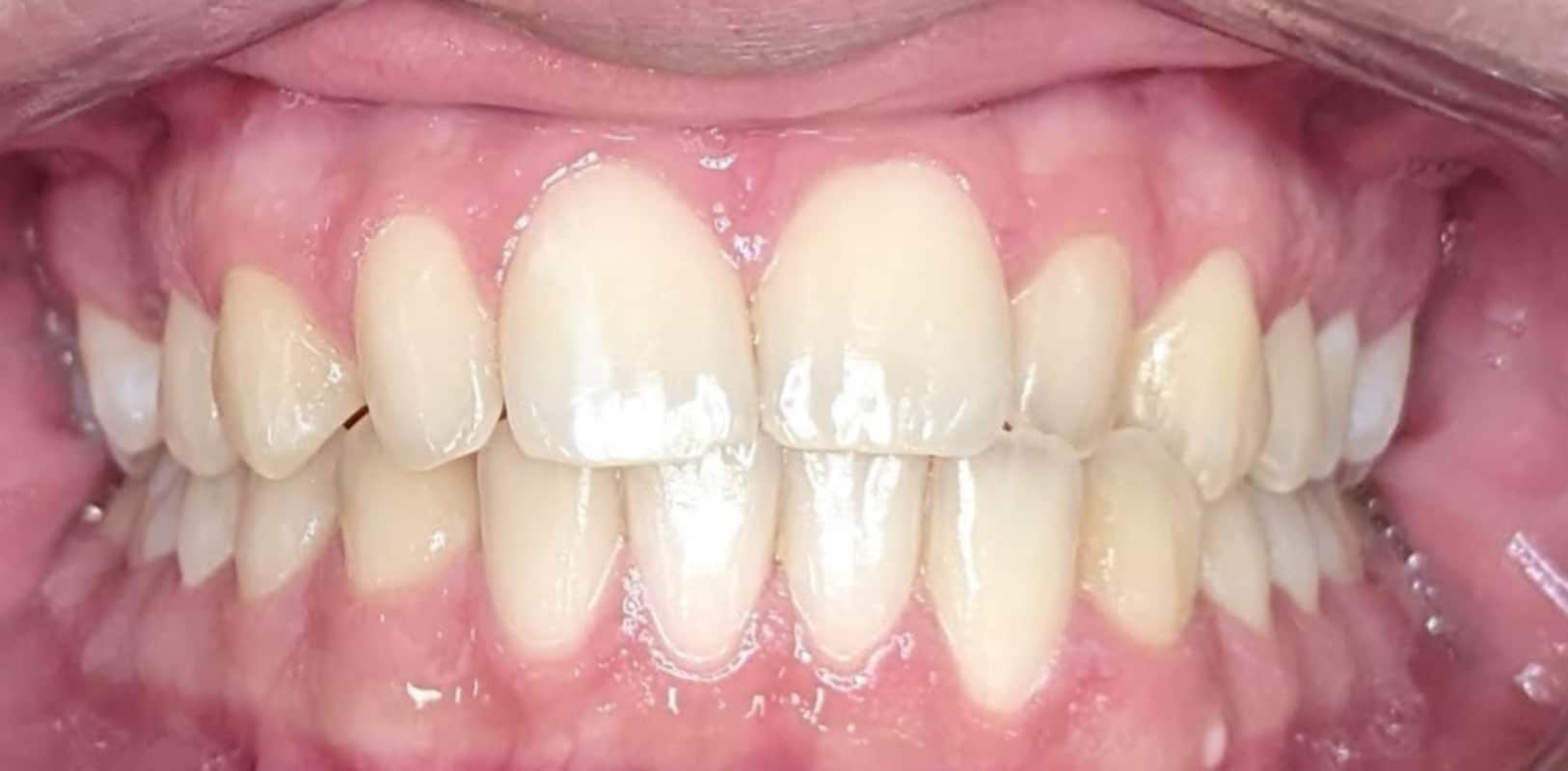 Lightforce clear braces 5 Before ceramic braces showing crowding and uneven alignment at hidden smiles orthodontics in new york