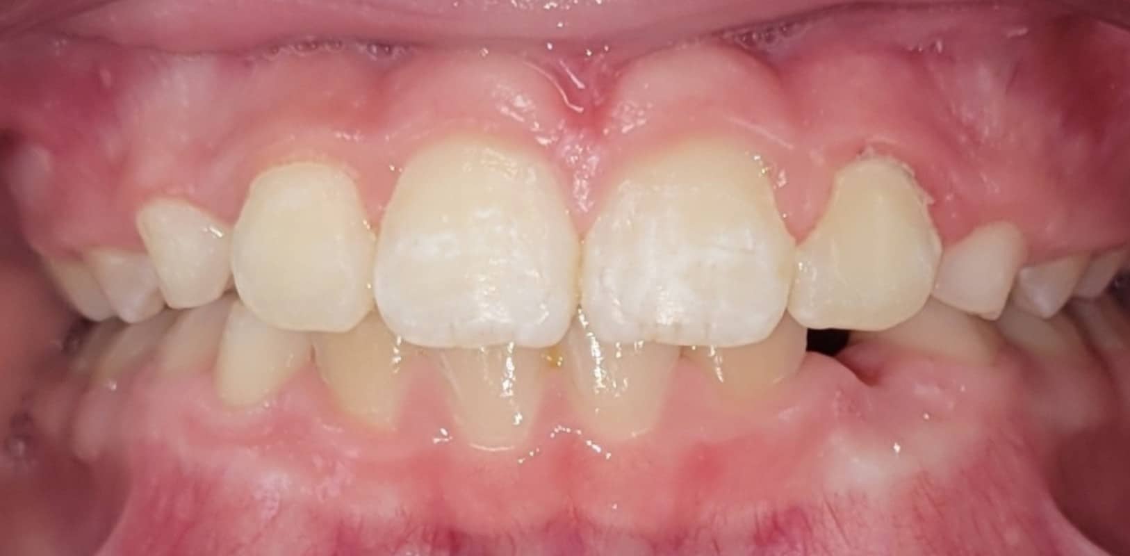 Orthodontics for all ages 6 After phase 1 orthodontic treatment with improved bite and alignment in a developing smile at hidden smiles