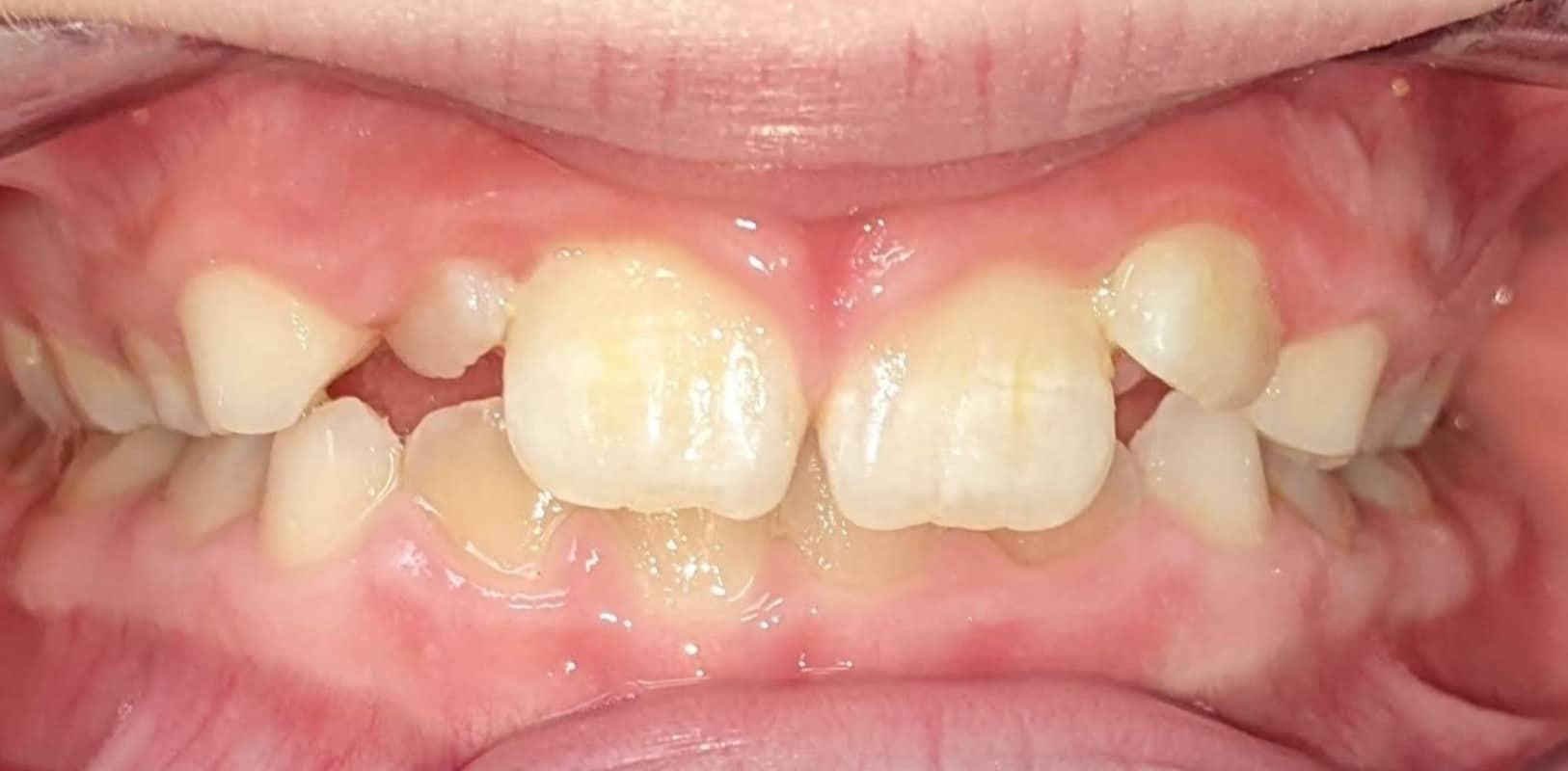 Orthodontics for all ages 5 Before phase 1 orthodontic treatment showing crowding and bite issues in a child’s developing smile at hidden smiles