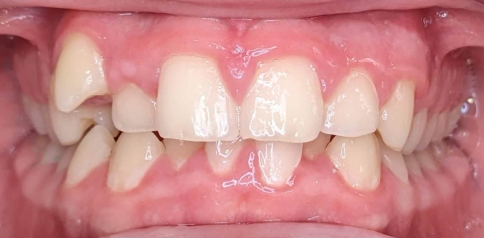 Invisalign® 3 Crooked teeth and spacing before orthodontic treatment in melville ny