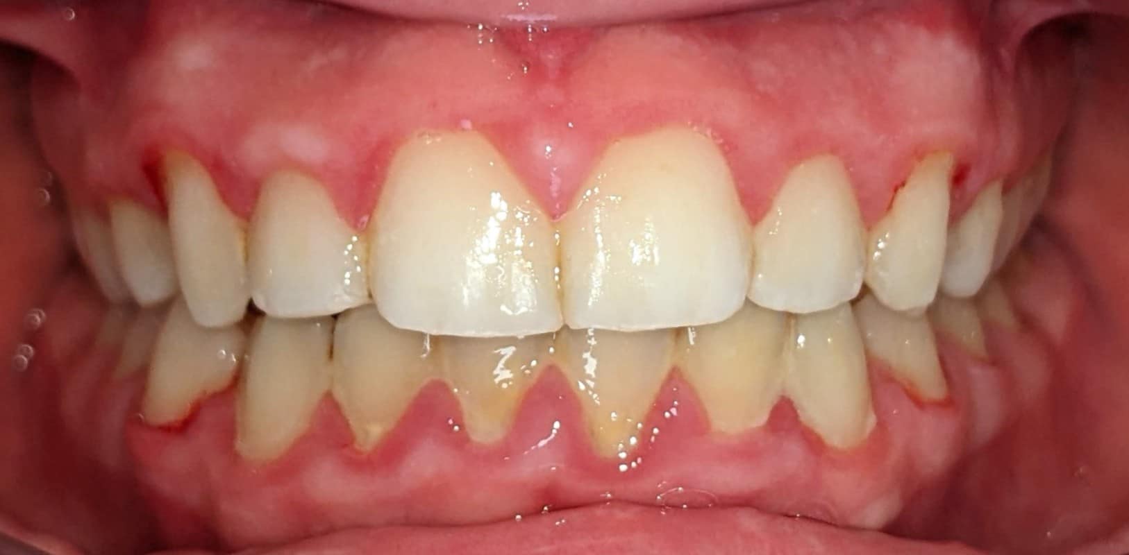 Invisalign® 4 Straight, aligned smile after orthodontic treatment at hidden smiles orthodontics in melville ny