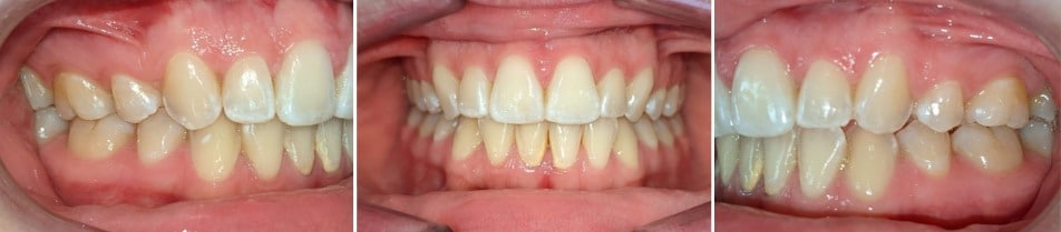 Insmile hidden braces 19 Jennifer after orthodontic treatment with hidden lingual braces showing improved alignment at hidden smiles orthodontics