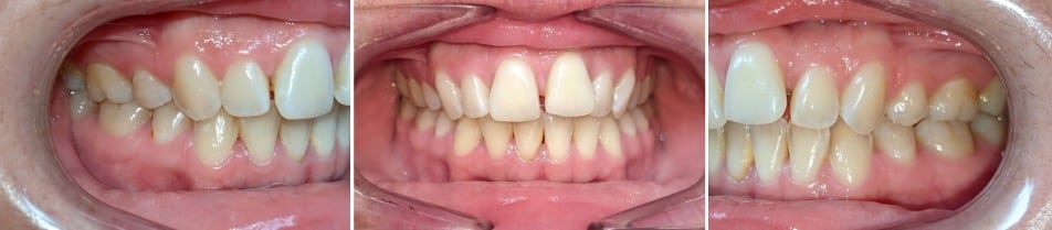 Insmile hidden braces 18 Jennifer before orthodontic treatment showing crowding and bite misalignment at hidden smiles orthodontics