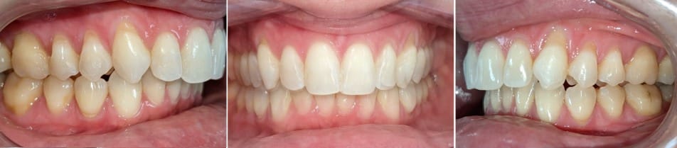 Insmile hidden braces 15 After orthodontic treatment correcting crowding with hidden braces at hidden smiles orthodontics