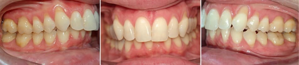 Insmile hidden braces 14 Before and after orthodontic treatment correcting crowding with hidden braces at hidden smiles orthodontics