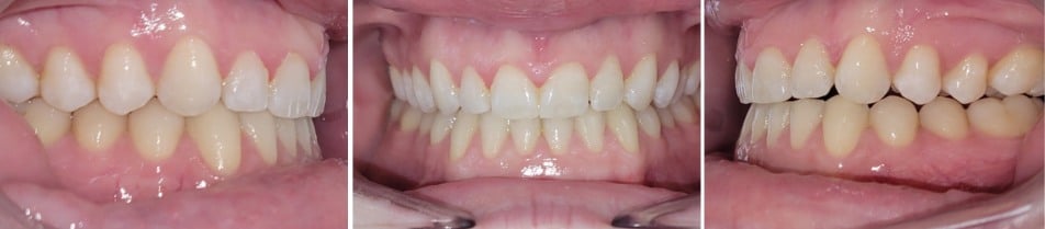 Insmile hidden braces 17 Before and after orthodontic treatment with lingual hidden braces at hidden smiles orthodontics