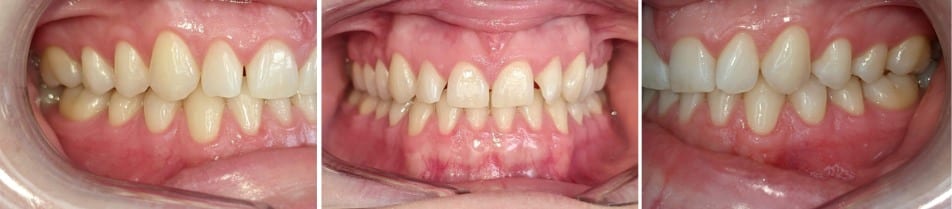 Insmile hidden braces 16 Before orthodontic treatment with lingual hidden braces at hidden smiles orthodontics