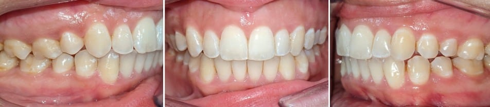 Insmile hidden braces 11 Before and after orthodontic treatment with hidden braces showing improved alignment at hidden smiles orthodontics