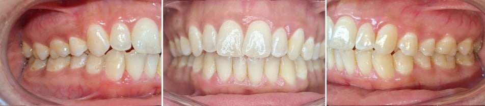 Insmile hidden braces 10 Before and after orthodontic treatment with hidden braces showing improved alignment at hidden smiles orthodontics